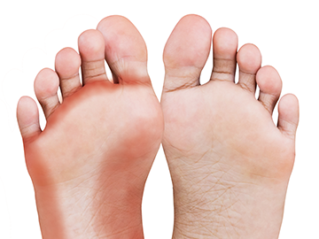 Bare feet with athlete’s foot on the sole of the left foot